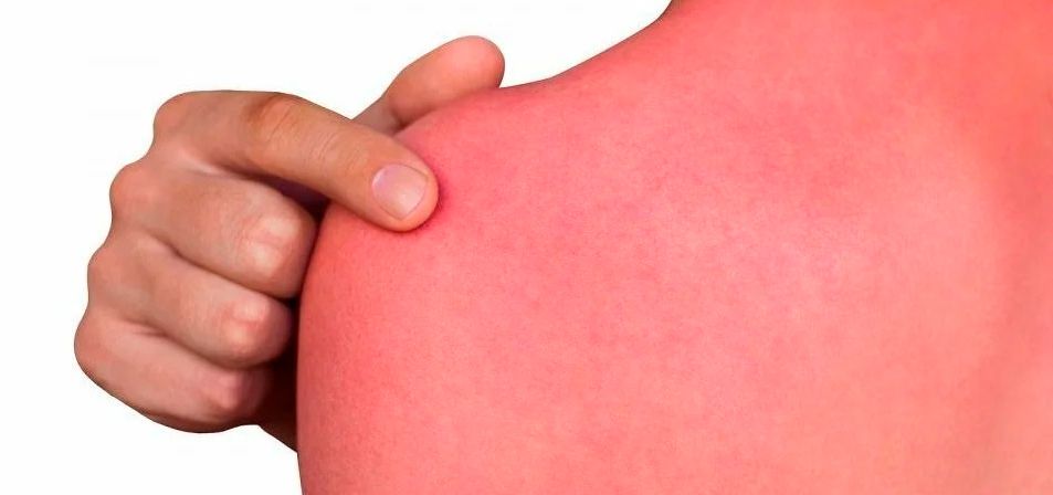 Солнечная аллергия кожи