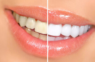 6 способов безопасно отбелить зубы в домашних условиях