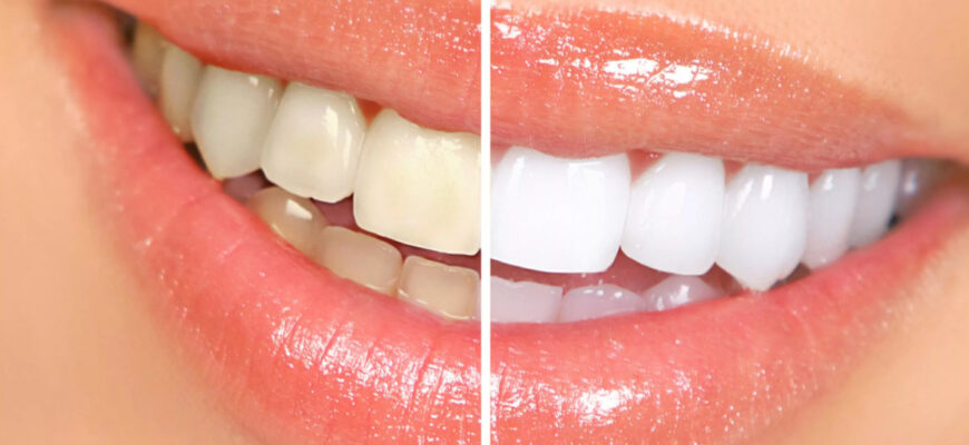 6 способов безопасно отбелить зубы в домашних условиях